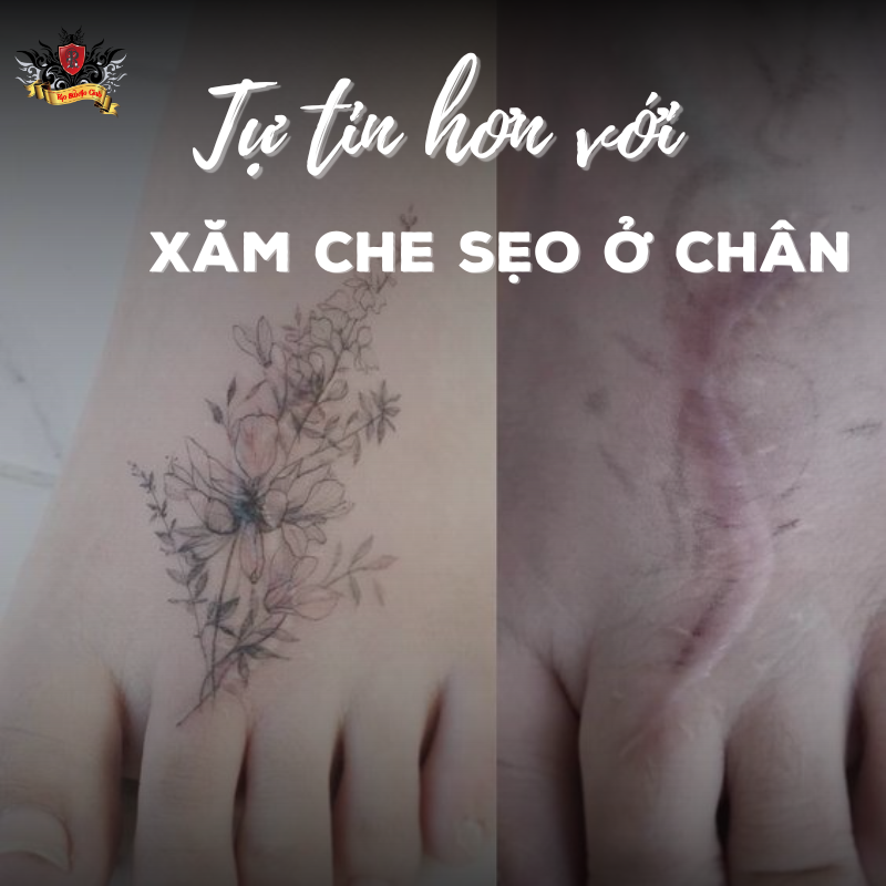 Tự tin hơn với xăm che sẹo ở chân