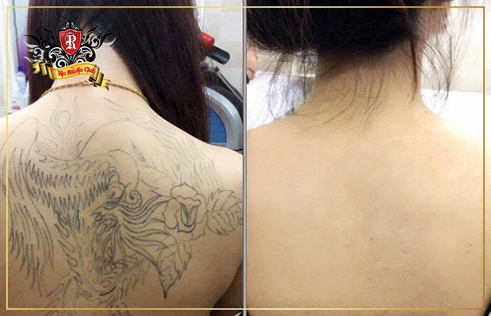 Rio Tattoo Studio còn nổi tiếng với dịch vụ xóa xăm